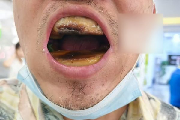 天津一名男子花5元網購樹脂材料自行補牙，導致口腔內猶如黏著一坨「烤年糕」。（網路圖片）